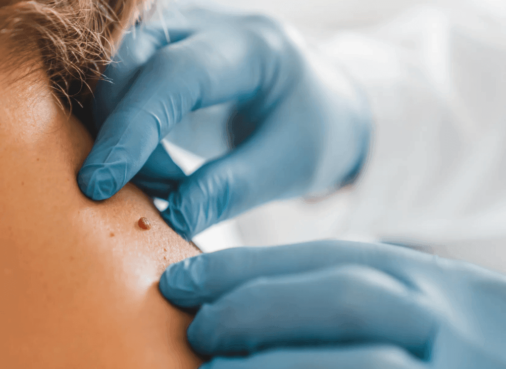 Close-up of a dermatologist examining a mole on a patient's skin with gloved hands.